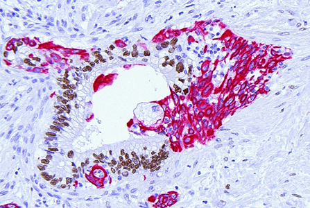 Immunhistochemisch gefärbter Schnitt mit intensiver roter Zellmarkierung