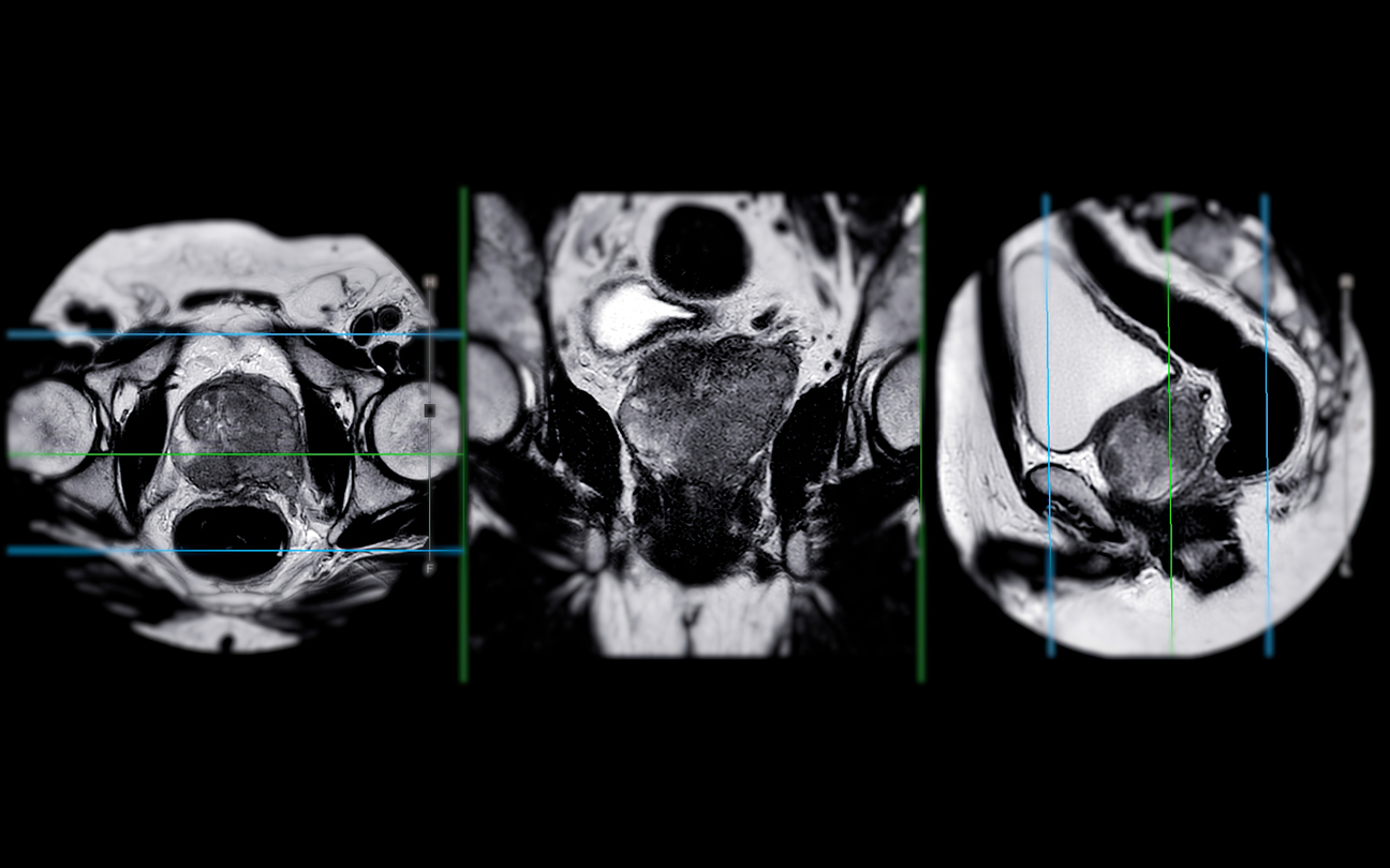 Drei MRT-Bilder des Beckenbereichs in verschiedenen Ansichten zur Diagnoseanalyse